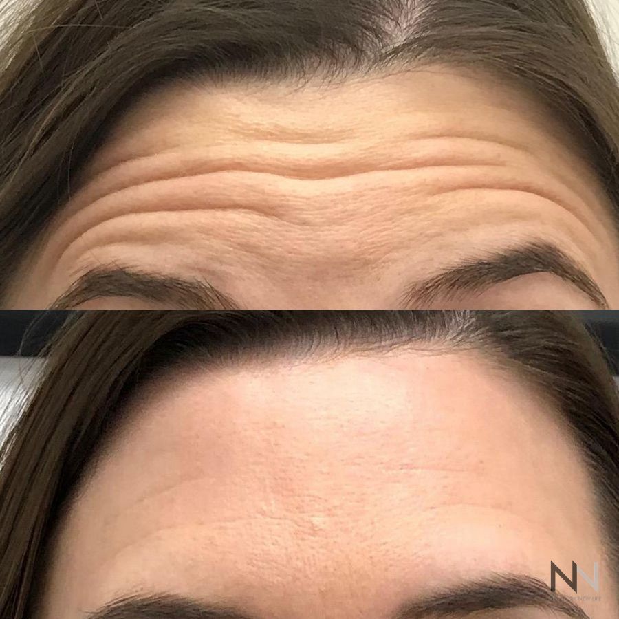 Botox and Dysport - Case 2190