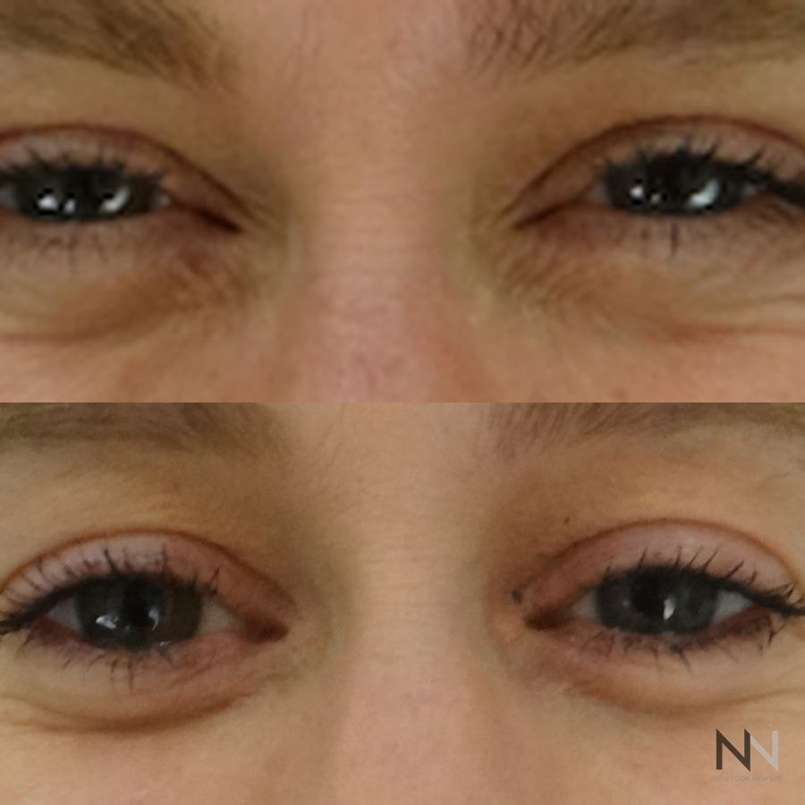 Botox and Dysport - Case 2199
