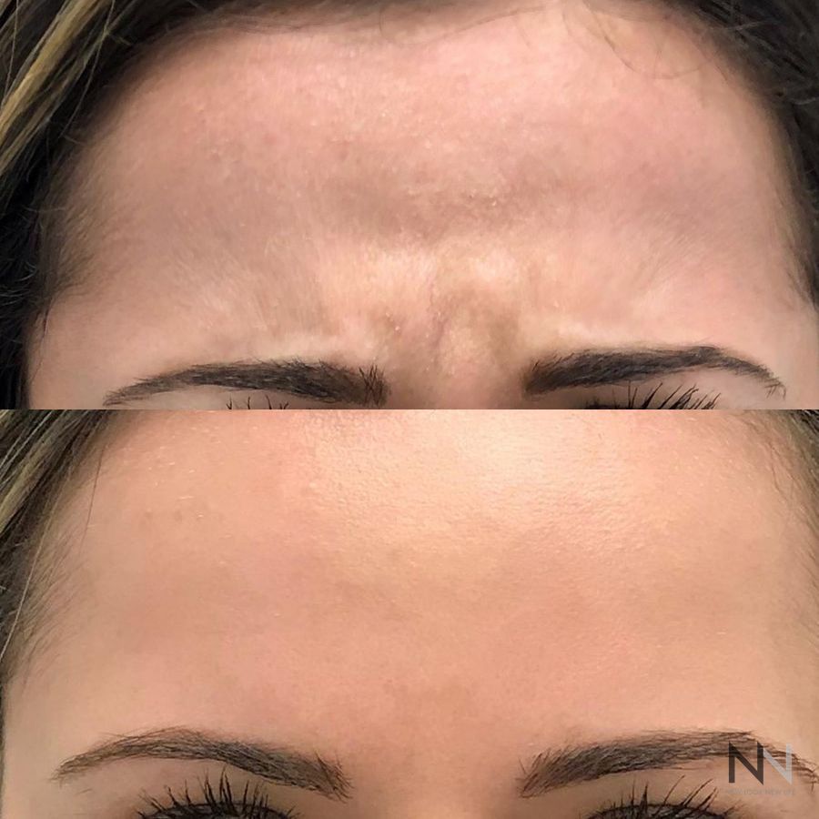 Botox and Dysport - Case 1672