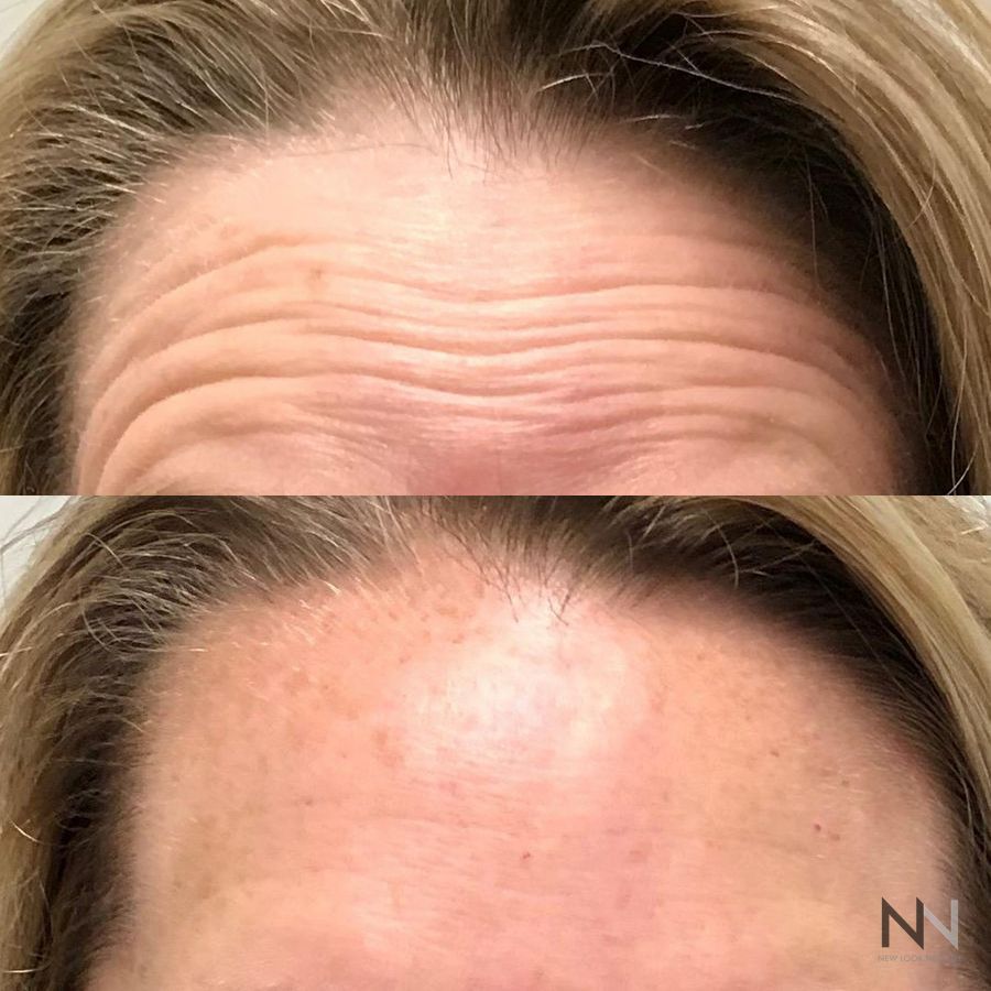 Botox and Dysport - Case 2205