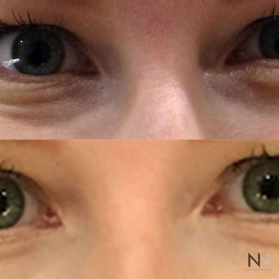 Botox and Dysport - Case 1670