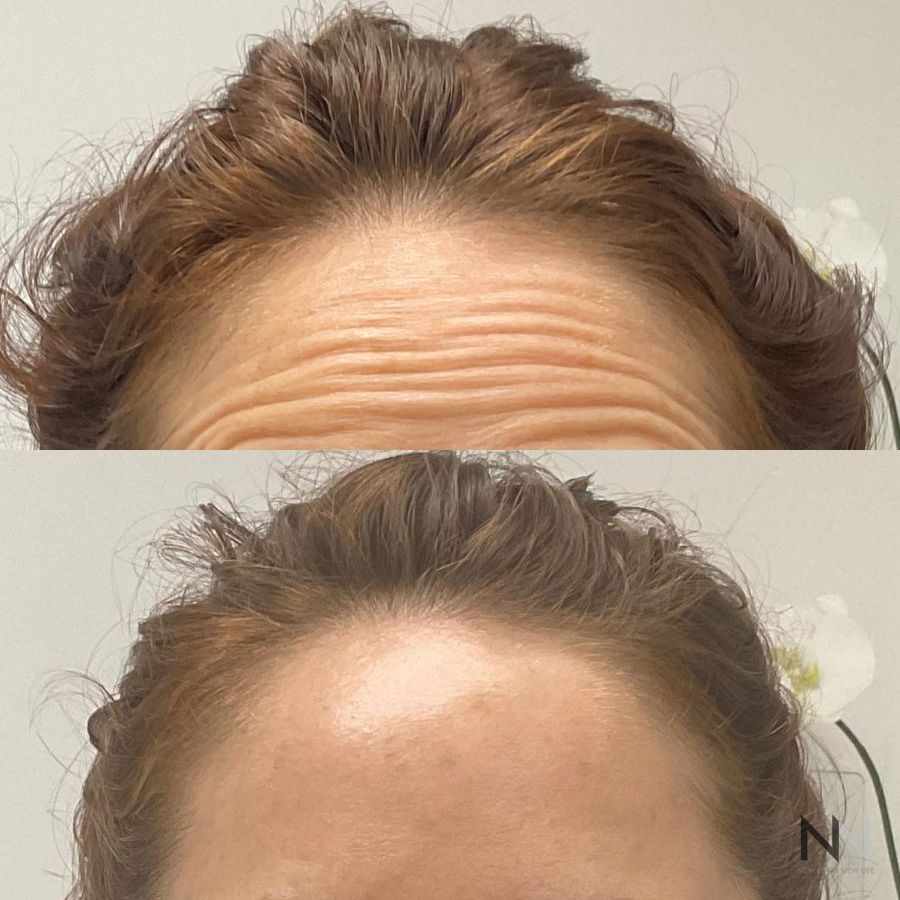 Botox and Dysport - Case 1682