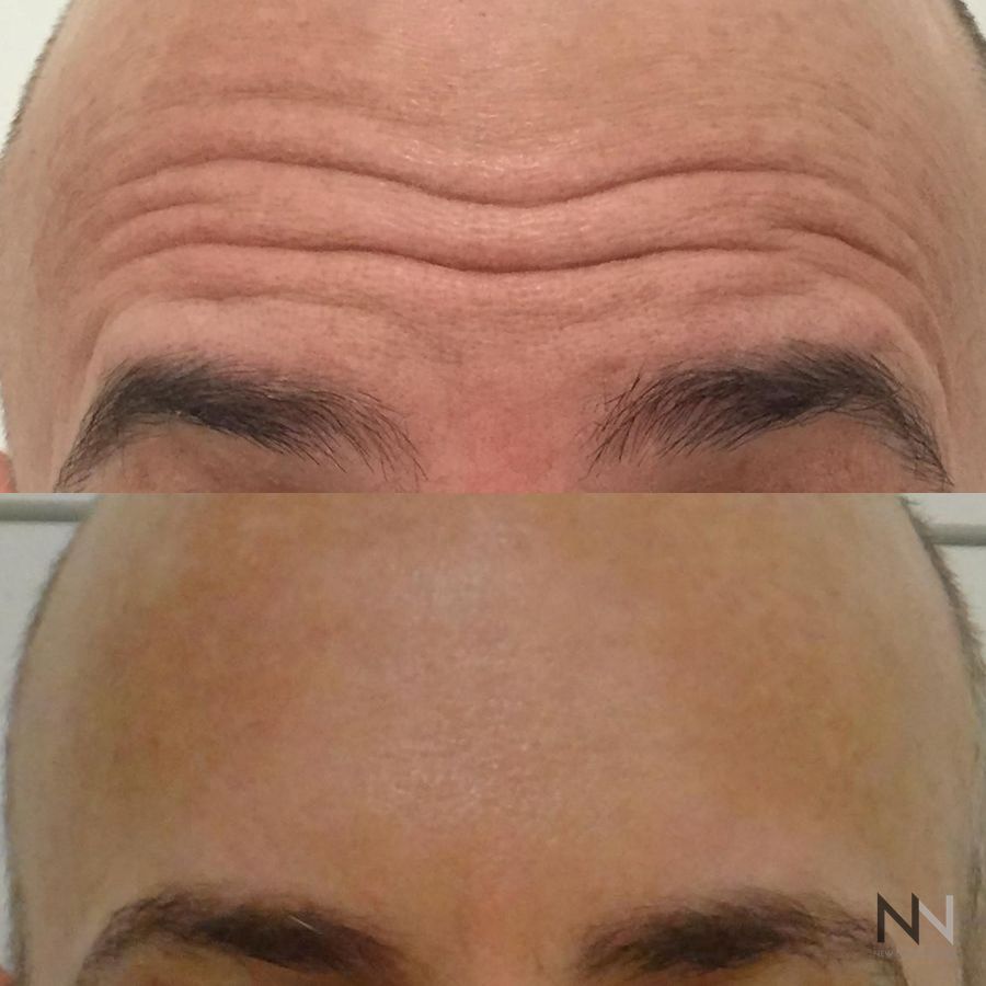 Botox and Dysport - Case 1674