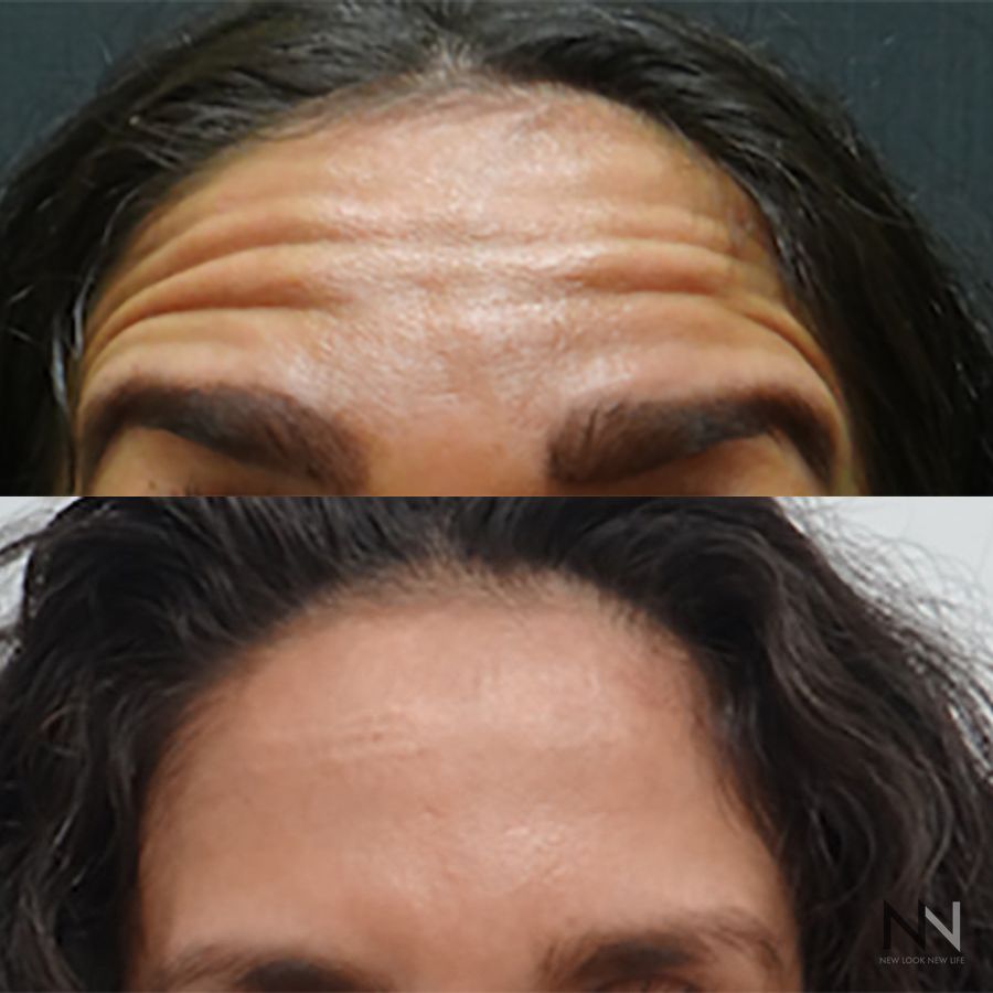 Botox and Dysport - Case 1678