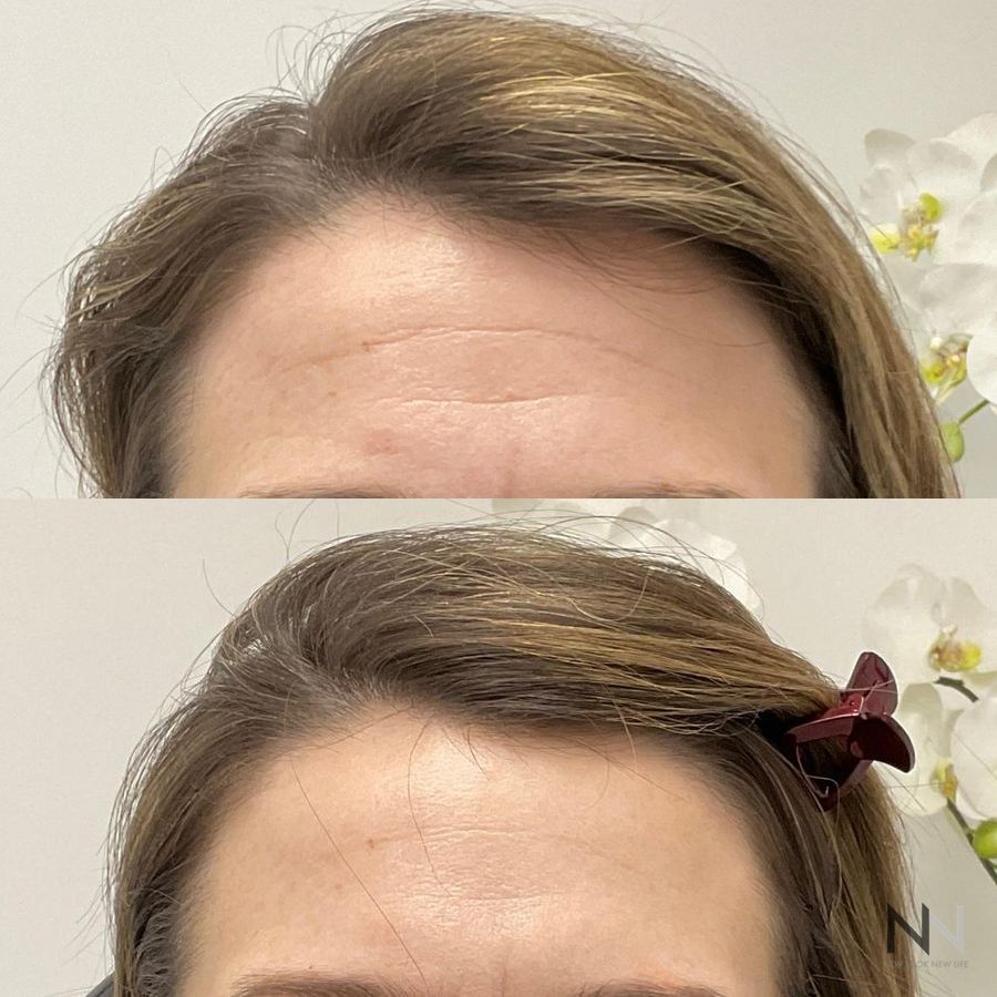 Botox and Dysport - Case 1683