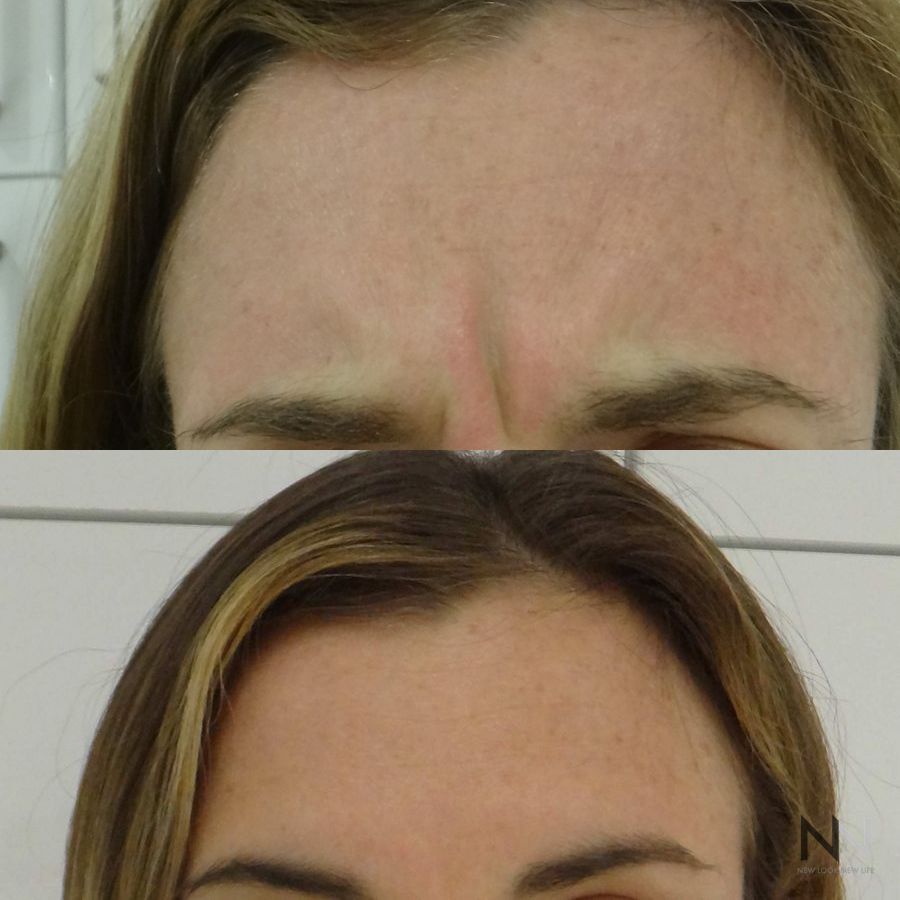 Botox and Dysport - Case 2198