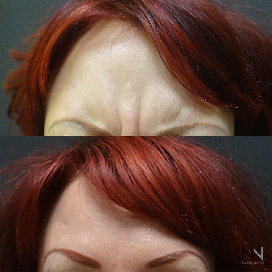 Botox and Dysport - Case 1679