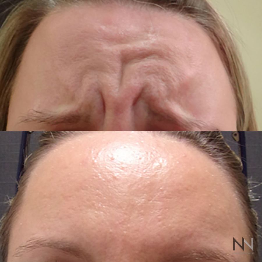 Botox and Dysport - Case 1662