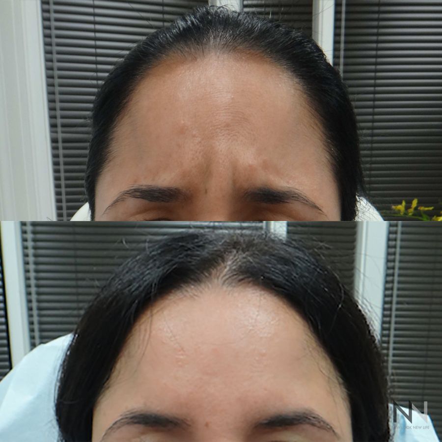 Botox and Dysport - Case 1666