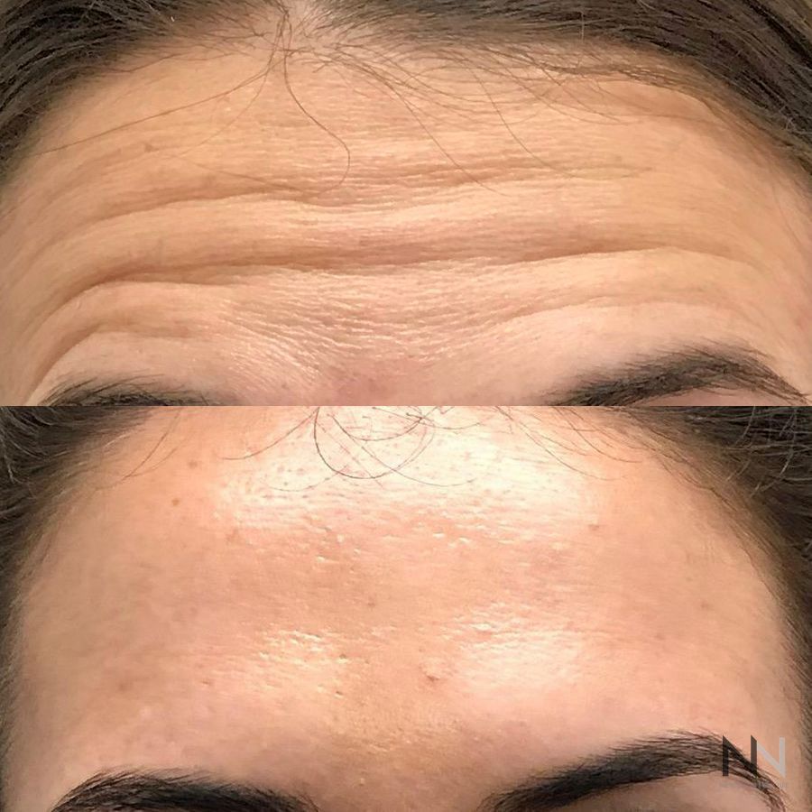 Botox and Dysport - Case 1673