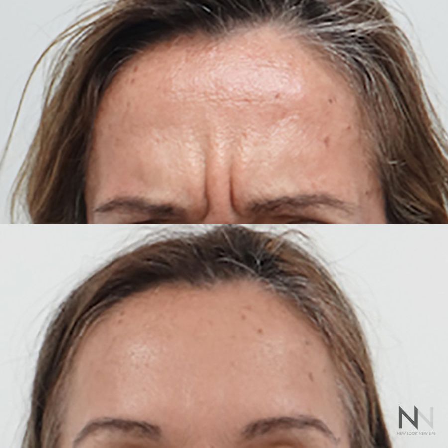 Botox and Dysport - Case 1681