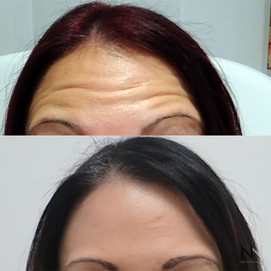 Botox and Dysport - Case 1680