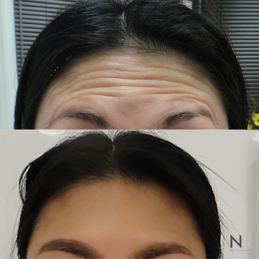 Botox and Dysport - Case 2194