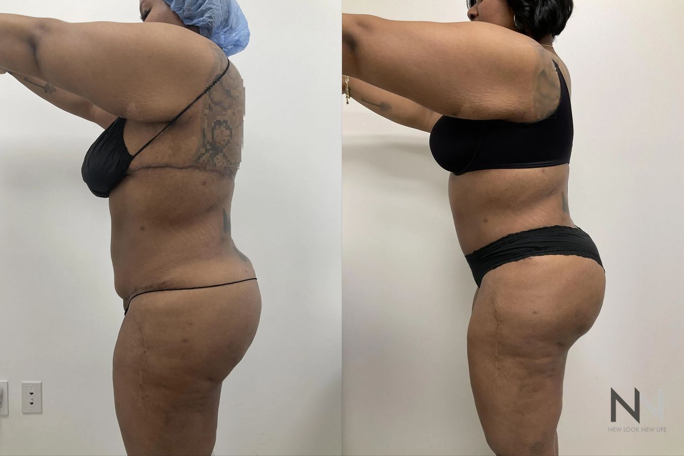 Before and after Liposuction case 21343 - Angle 4