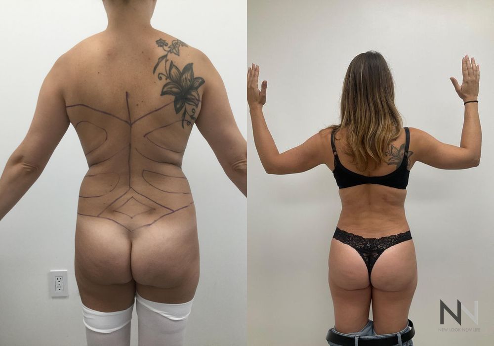Brazilian Butt Lift - Case 1794