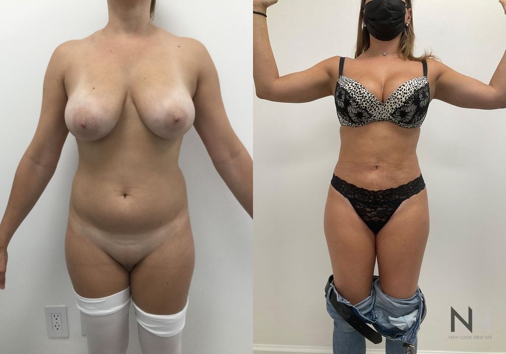 Brazilian Butt Lift - Thumbnail 2