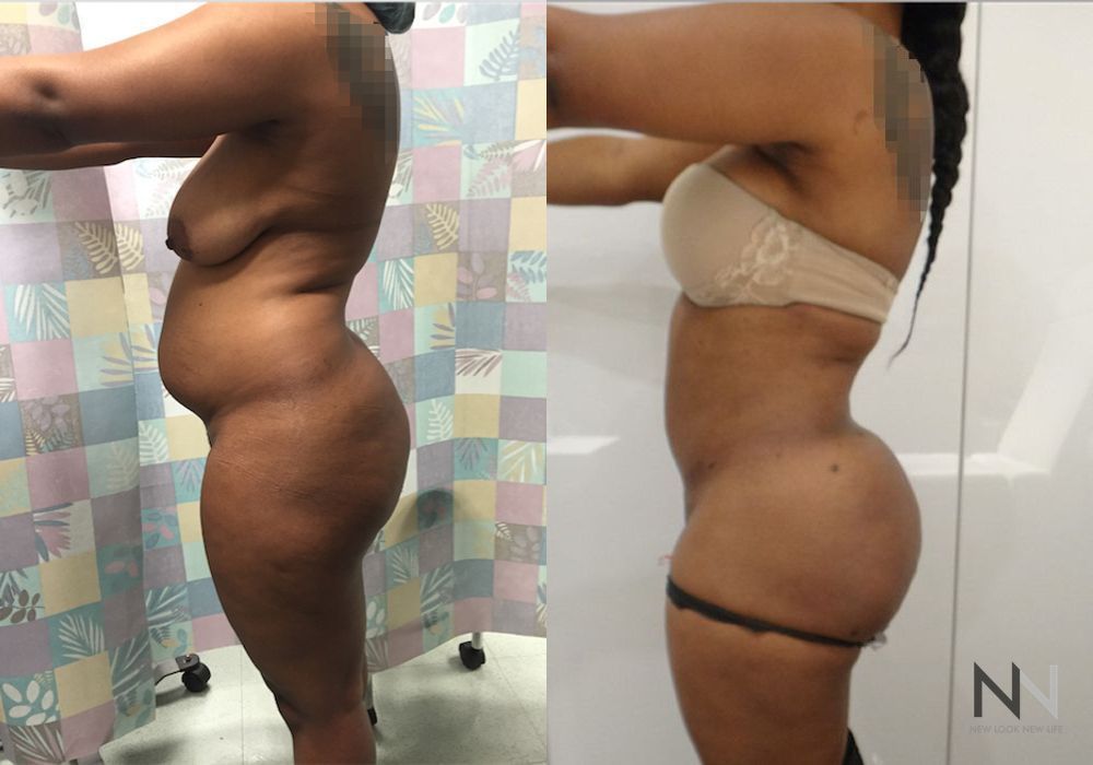 Brazilian Butt Lift - Thumbnail 4