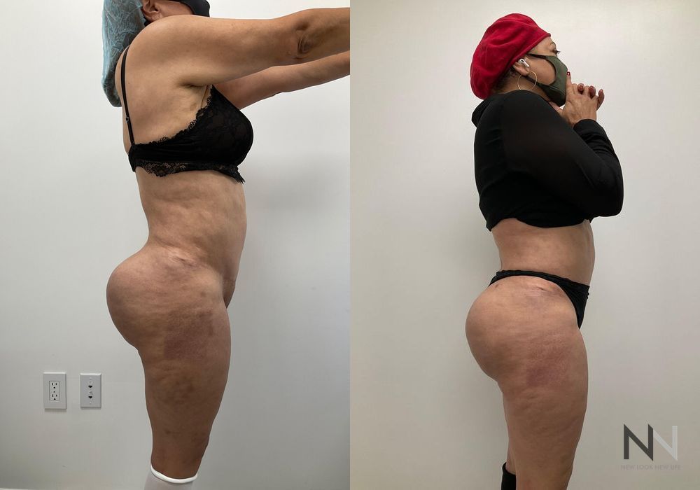 Brazilian Butt Lift - Thumbnail 2