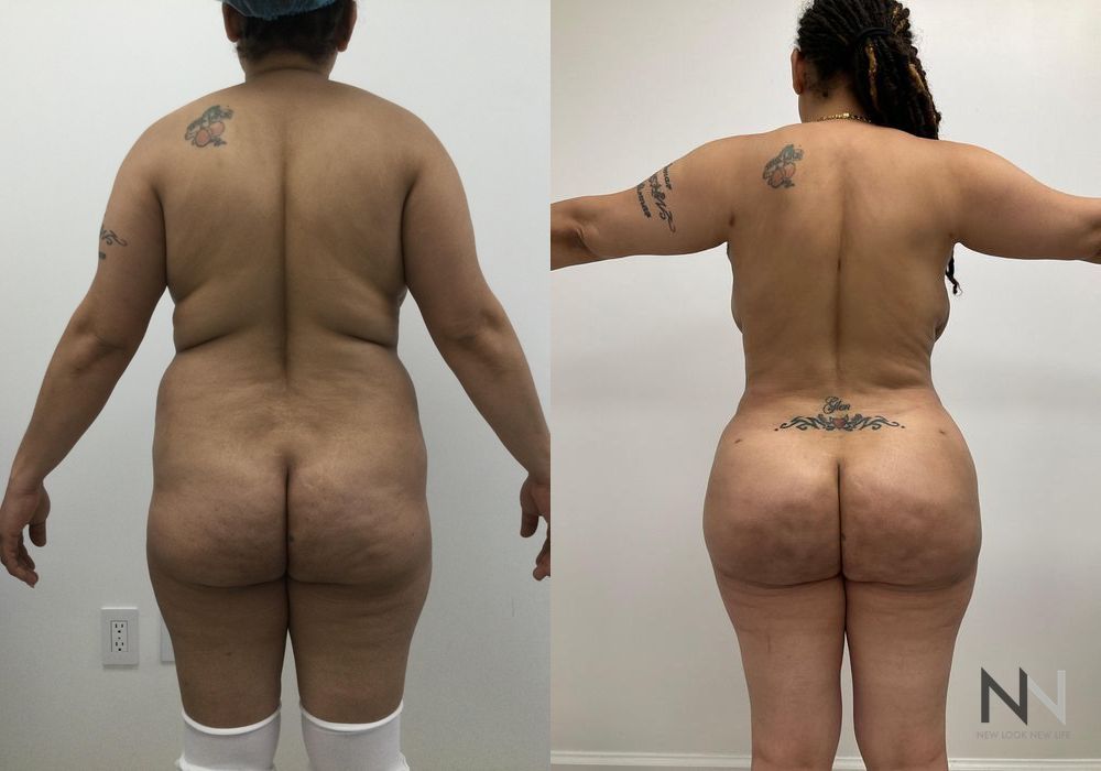 Brazilian Butt Lift - Thumbnail 2