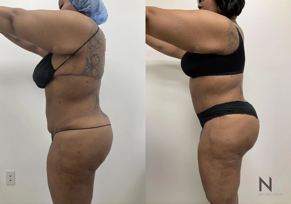 Brazilian Butt Lift - Thumbnail 4