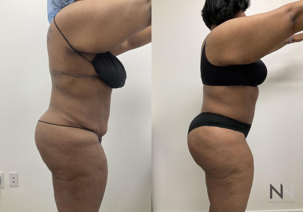 Brazilian Butt Lift - Thumbnail 4