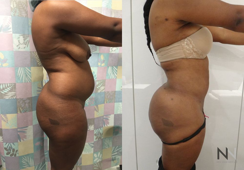 Brazilian Butt Lift - Case 1798