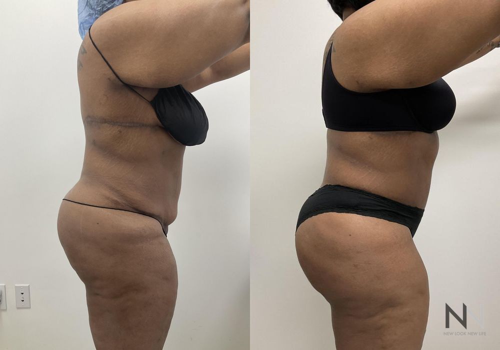 Brazilian Butt Lift - Thumbnail 3