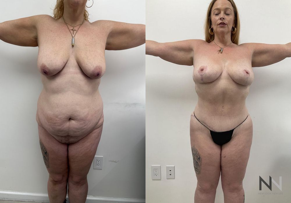 Brazilian Butt Lift - Case 1801