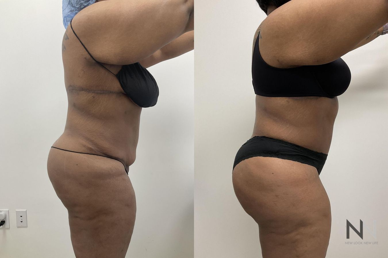 Before and after Liposuction case 21343 - Angle 3