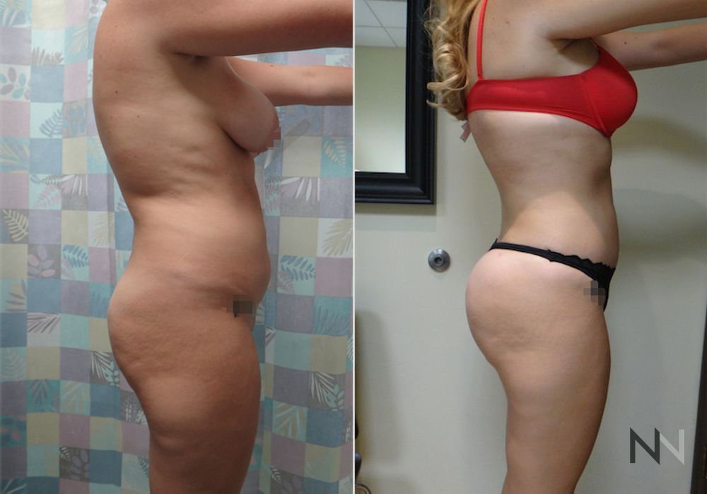 Brazilian Butt Lift - Case 1795