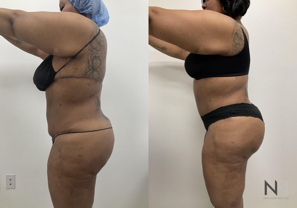 Brazilian Butt Lift - Thumbnail 3