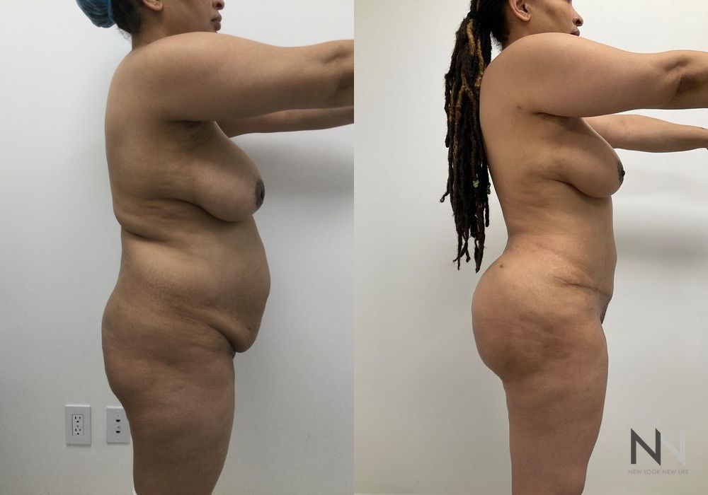 Brazilian Butt Lift - Thumbnail 3