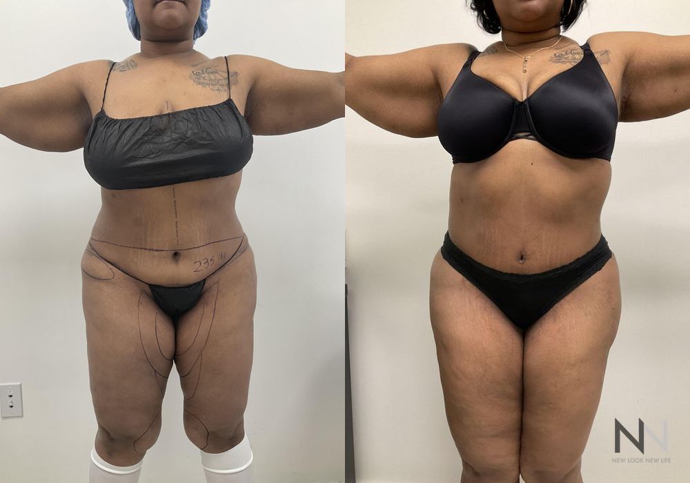 Brazilian Butt Lift - Case 1802