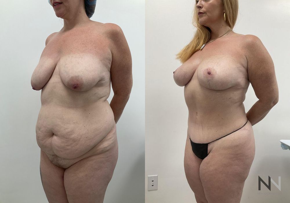 Brazilian Butt Lift - Thumbnail 2