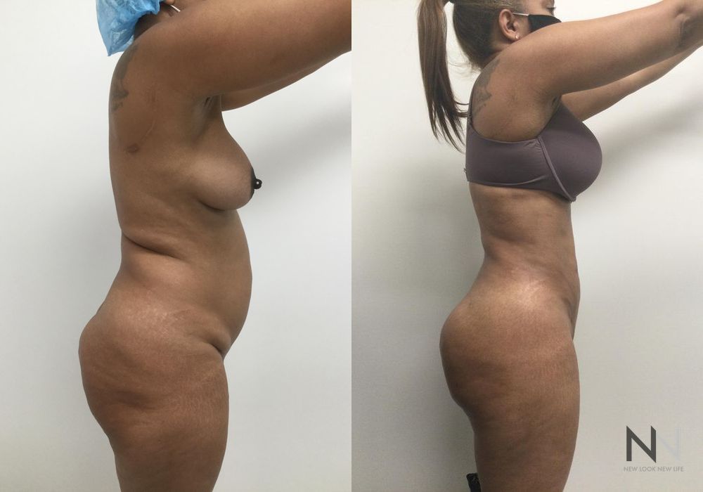 Brazilian Butt Lift - Thumbnail 2