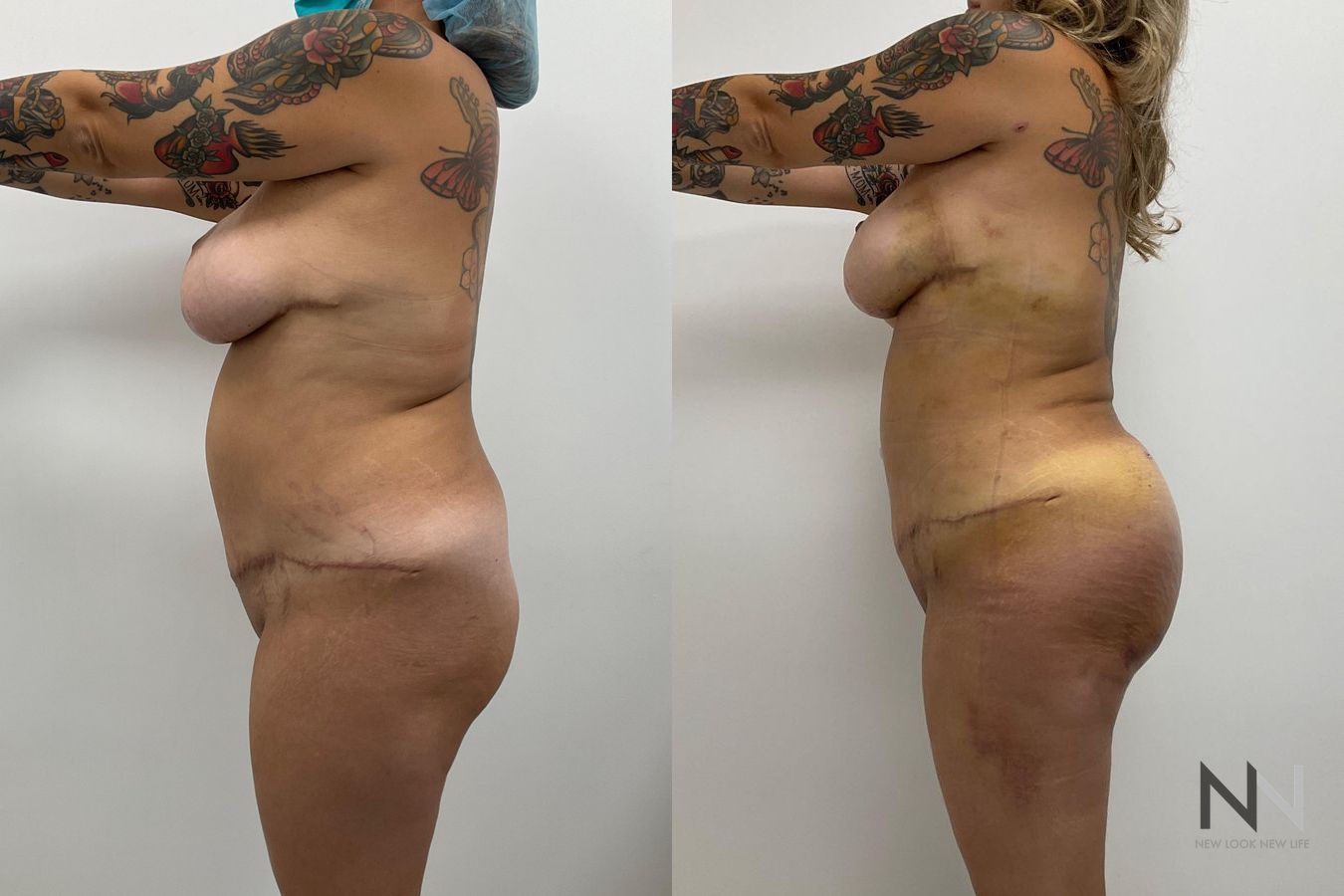 Before and after Brazilian Butt Lift six months results - Angle 3