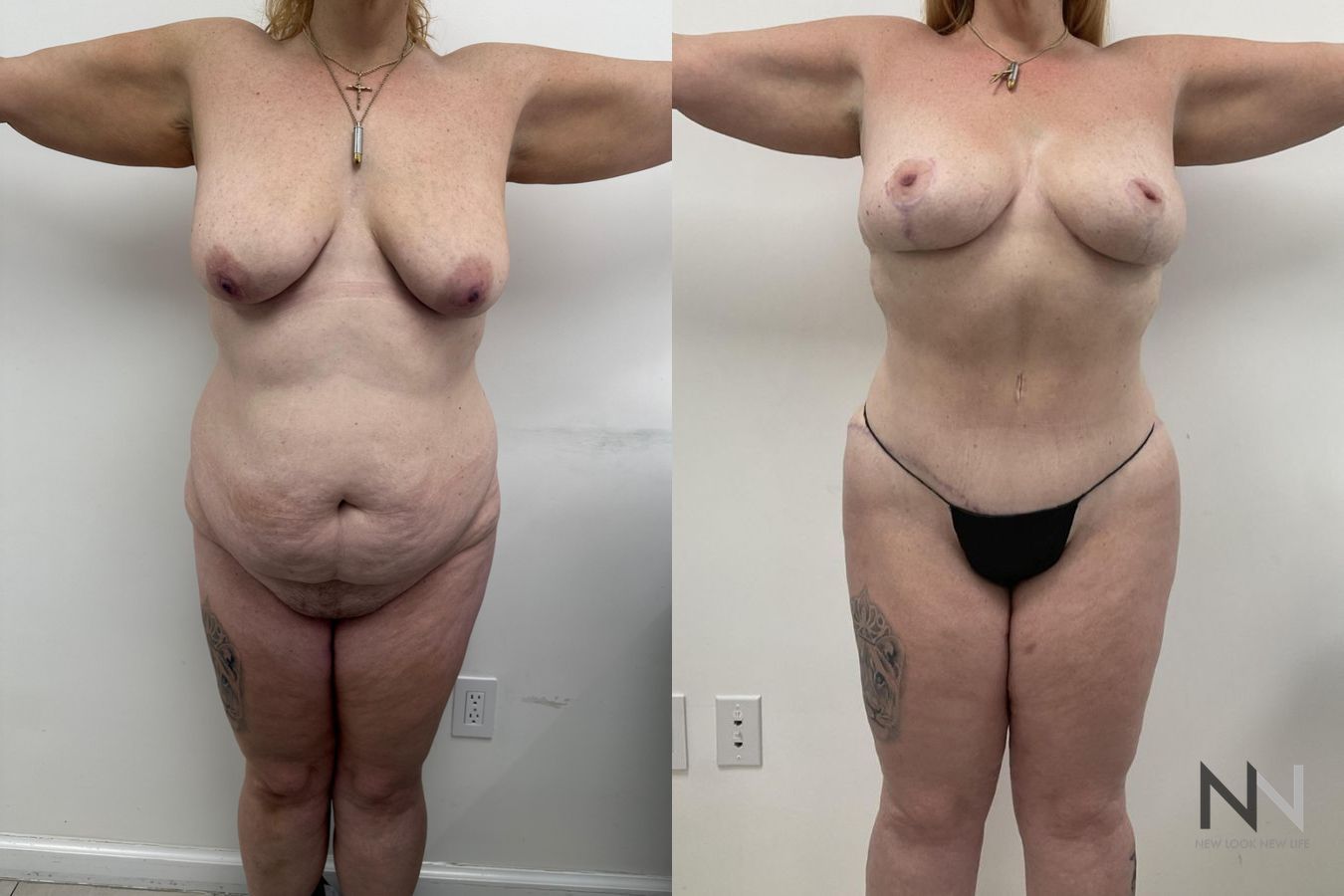 Body contour improvement after mommy makeover