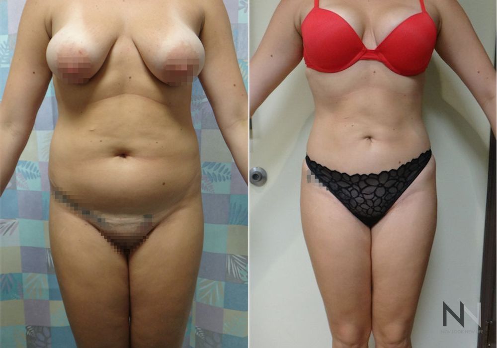 Brazilian Butt Lift - Thumbnail 3