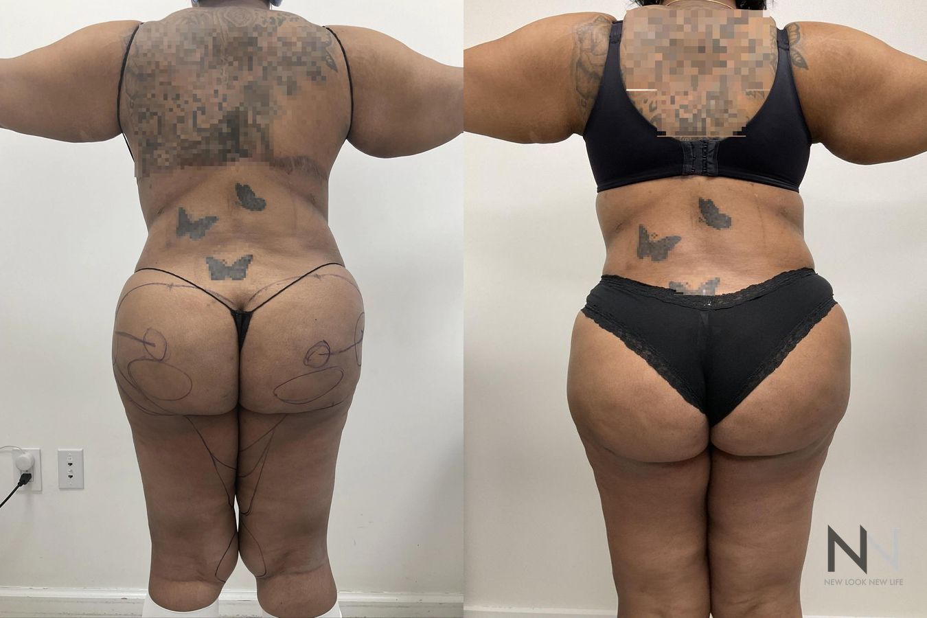 Before and after Liposuction case 21343