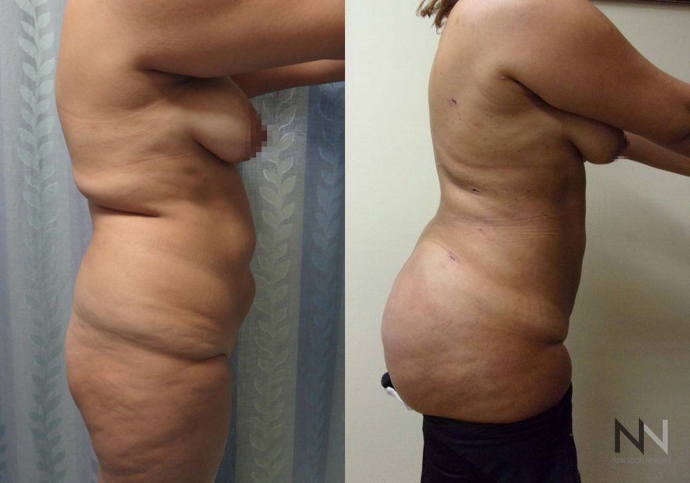 Brazilian Butt Lift - Thumbnail 3