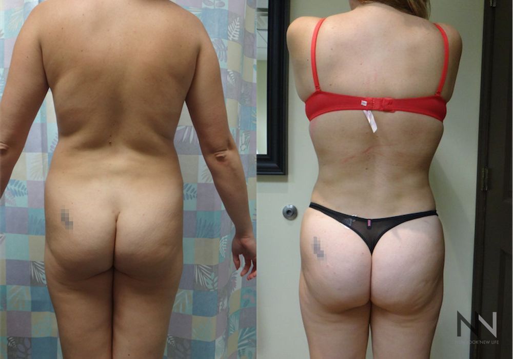 Brazilian Butt Lift - Thumbnail 4