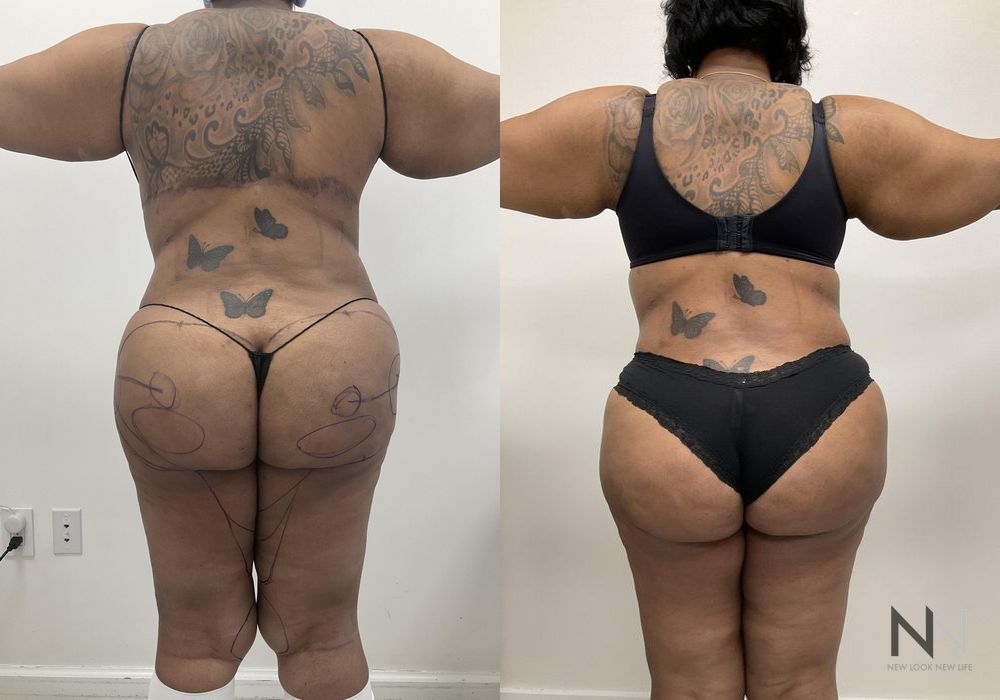 Brazilian Butt Lift - Thumbnail 2