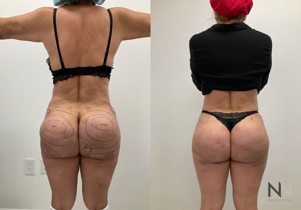 Brazilian Butt Lift - Case 1790
