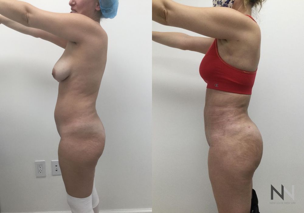 Brazilian Butt Lift - Thumbnail 4