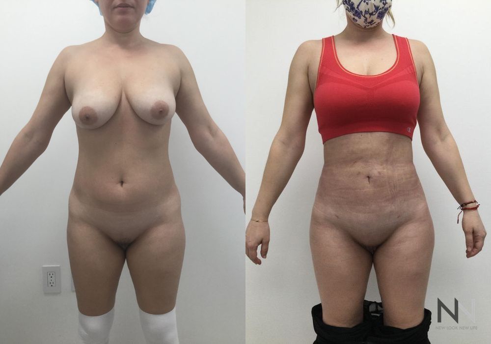 Brazilian Butt Lift - Case 1793