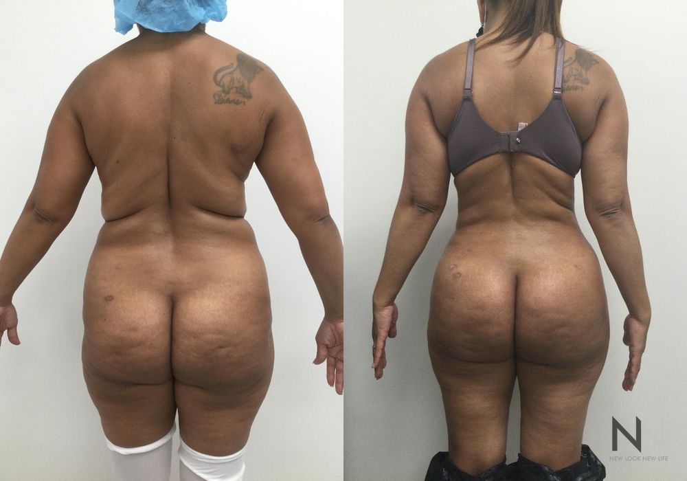 Brazilian Butt Lift - Case 1973