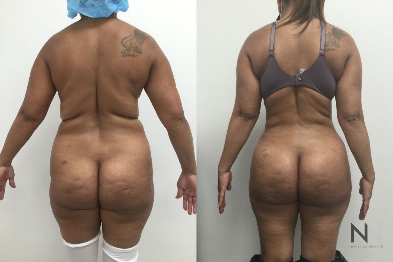 Before and after Brazilian Butt Lift with Lipo 360 showing slimmer waist and enhanced buttock projection at six months post-op.