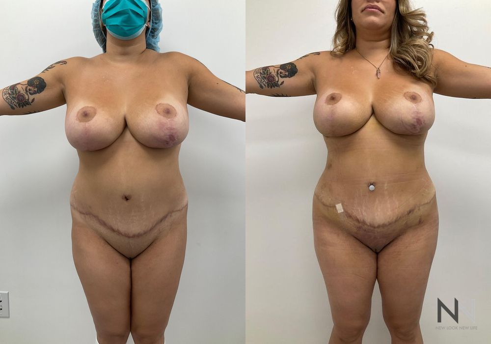 Brazilian Butt Lift - Case 1981