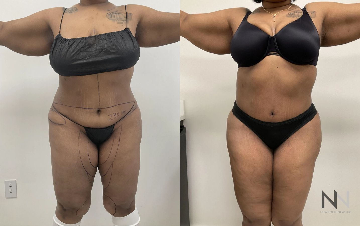 Before and after Liposuction case 21343 - Angle 2