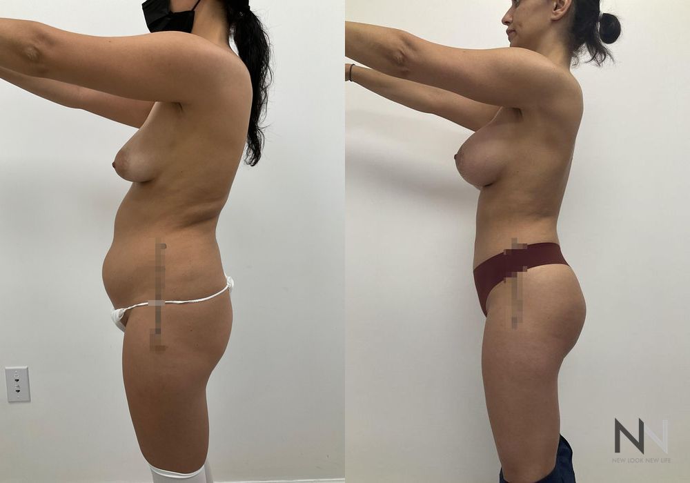 Brazilian Butt Lift - Thumbnail 4